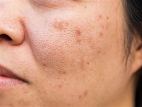 Problems Facial Skin Is Acne And Blemishes 7426688 Stock Photo At Vecteezy