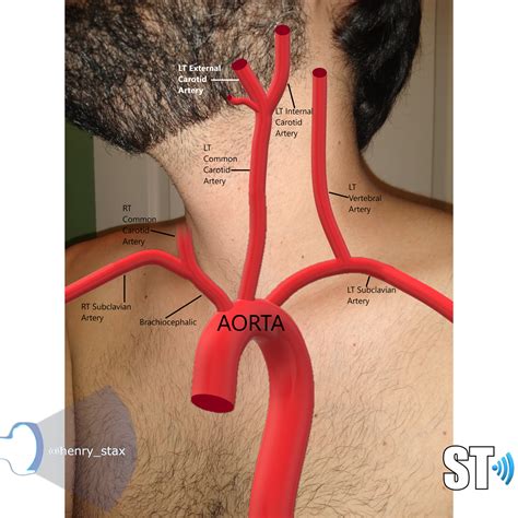 Carotid Duplex Sonographic Tendencies Medical Anatomy Medical