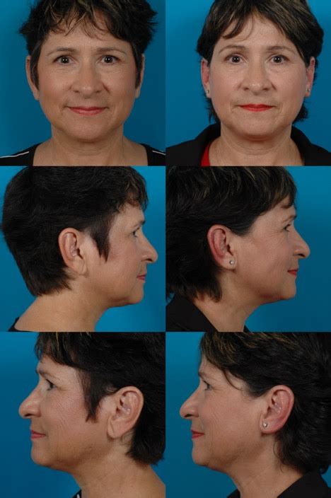 Ear Surgery Otoplasty Swanson Center For Cosmetic Surgery