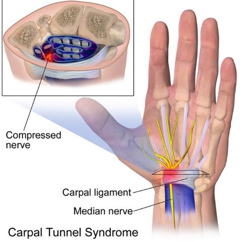 This page reflects the latest version of the apa publication manual (i.e., apa 7), which released in october 2019. Apa Itu Carpal Tunnel Syndrome - khusien