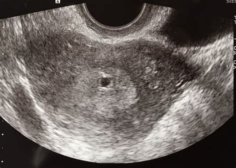 Possible Blighted Ovum 5w7d Us Pic Babycenter
