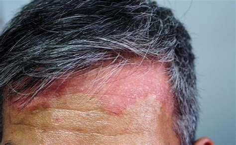 Seborrheic Dermatitis Face Treatment Pictures Photos