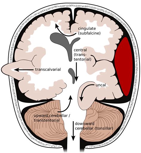 Types Of Brain Herniation 3 1 Uncal 2 Central 3 Cingulate Or Sub