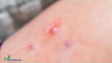 Bump On Inner Thigh Causes Symptoms And Treatment