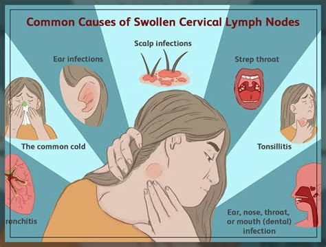 Swollen Lymph Nodes In Neck Dentist Ahmed Official Website
