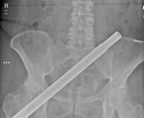 Shocking Ct Scans Show How Woman Was Impaled By Christmas Tree