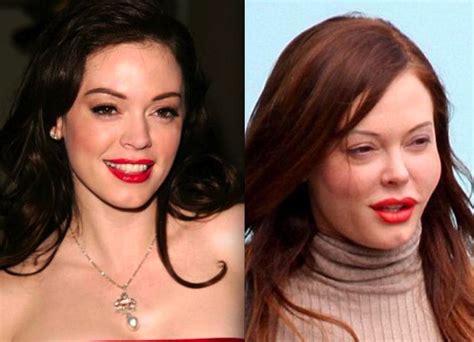 Rose Mcgowan Plastic Surgery Gone Wrong Before And After Pictures