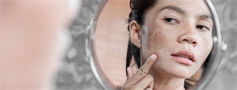 The 19 Best Melasma Creams The Dermatology Review