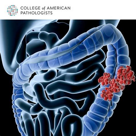 Occasional cramps or bloating are common digestive issues that can occur due to an upset stomach, gas, or eating certain foods. Diagnosing Advanced Colorectal Cancer: What Pathologists ...