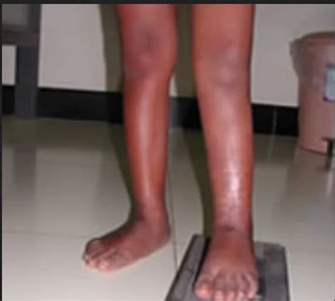 Limb Lengthening And Deformity Treatment Services In Coonoor Ortho One