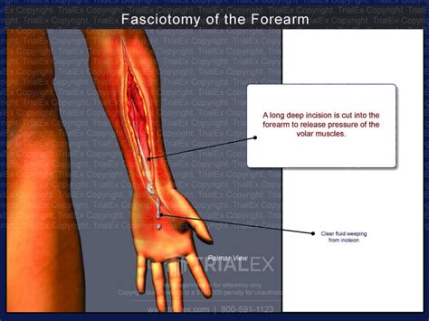 Fasciotomy Of The Forearm Trial Exhibits Inc