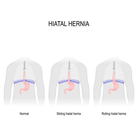 Hernia Illustrations Royalty Free Vector Graphics And Clip Art Istock