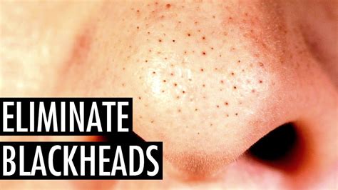 How To Get Rid Of Blackheads A Step By Step Guide For Men Tiege