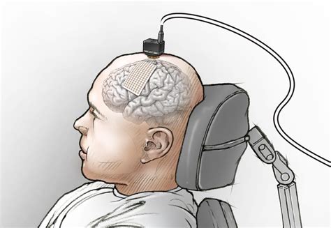 Brain Implants Let Paralyzed Man With Severe Speech Loss Speak Again