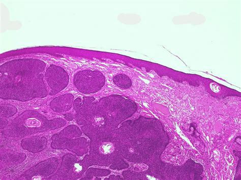 Basaalcelcarcinoom Bcc Basal Cell Carcinoma Ca Basocellulare