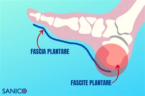 Fascite Plantare Cause Sintomi E Rimedi Della Patologia Dei Runner Hot Sex Picture