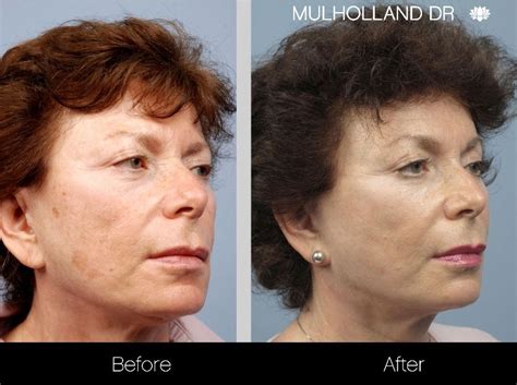 Fotofacial Before And After Photo Of Spamedica Toronto Patient