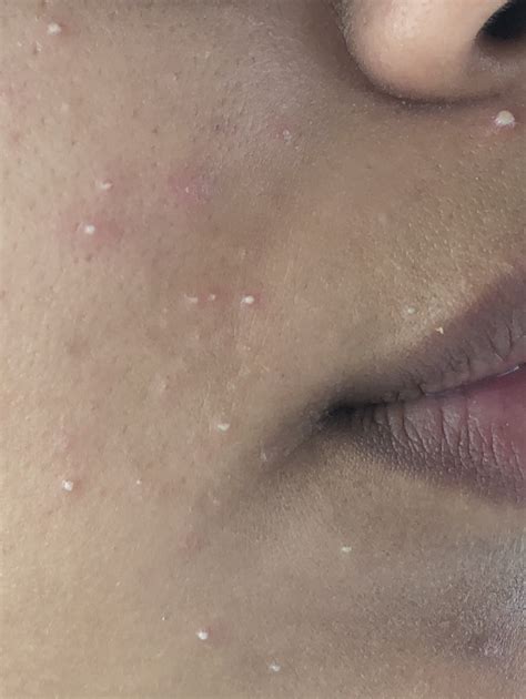 Can Anyone Explain What This Is Cluster Of Small White Bumps General Acne Discussion Acne