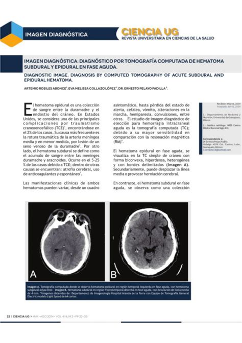 Pdf Diagnostic Image Diagnosis By Computed Tomography Of Acute Subdural And Epidural Hematoma