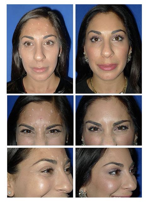 Botox Brow Lift Before And After Pictures Eyebrow Lift Using Botox