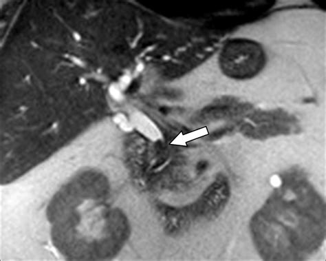 Uncommon Intraluminal Tumors Of The Gallbladder And Biliary Tract