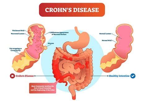 Best Crohns Disease Treatment Doctors Upper East Side Nyc