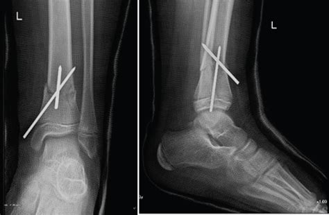 Distal Tibia Fracture