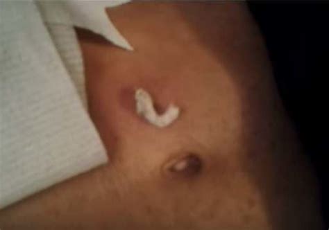 Sebaceous Cyst New Pimple Popping Videos