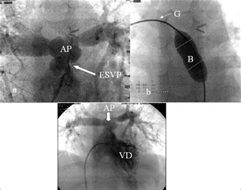 A Angiografía De La Arteria Pulmonar Ap En Proyección Postero