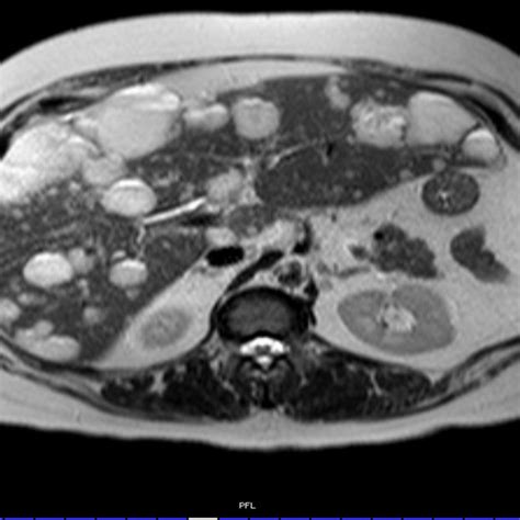 Portal Phase Ct Post Contrast Showing Multiple Liver Lesions With