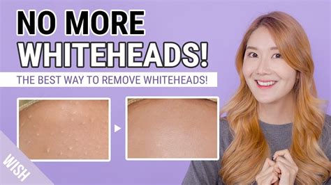 How To Remove Whiteheads 20 Blackheadwhitehead Removal Youtube