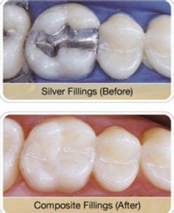 Amalgam fillings are not often used now, as there are newer and safer alternatives. Safe Amalgam Fillings Removal Dentist Tacoma | Safe ...