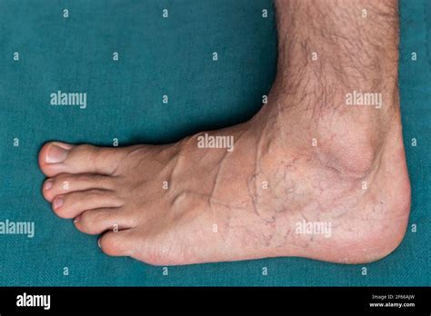 Varicose Veins Leg And Foot High Resolution Stock Photography And