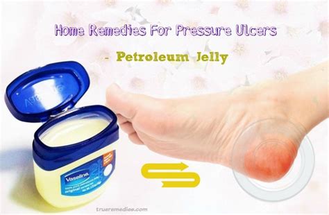 20 Home Remedies For Pressure Ulcers Bed Sores Relief 2022