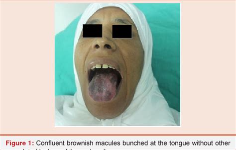 Figure 1 From Acquired Immunodeficiency Syndrome Revealed By Oral