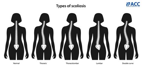 Scoliosis Types