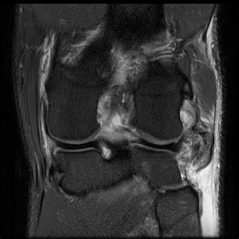 Radiology Cases Torn Lcl And Biceps Femoris Tendon