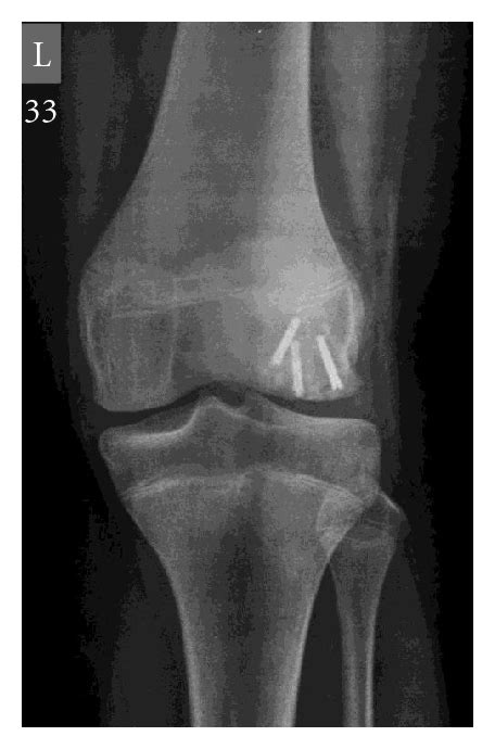 Osteochondral Fracture Lateral Femoral Condyle Treated With ORIF Using Z Plasty A Modification