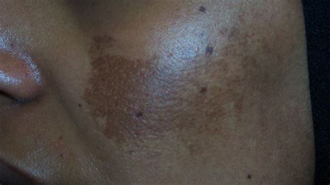 Light Skin Discoloration On Forehead