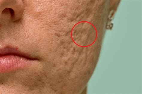 Why Your Acne Scar Laser Treatment Isnt Working Introducing Secret Rf