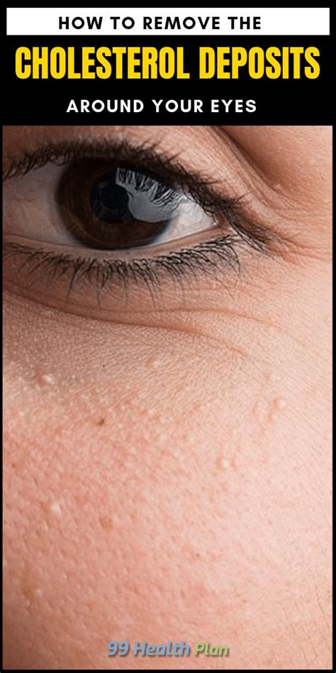 How to Remove the Cholesterol Deposits Around Your Eyes in 2020 (With