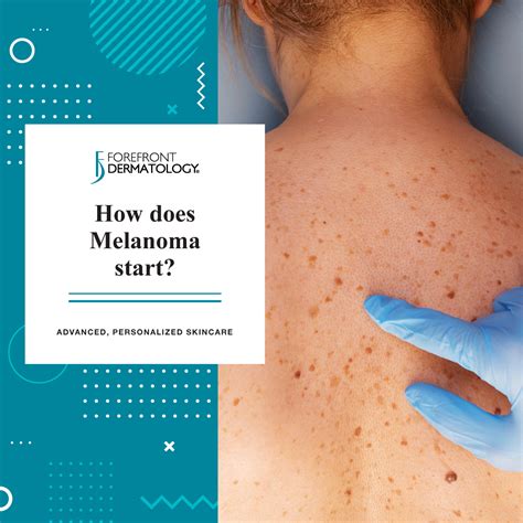 How Does Melanoma Start Forefront Dermatology