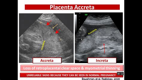 Placenta Lesions Imaging