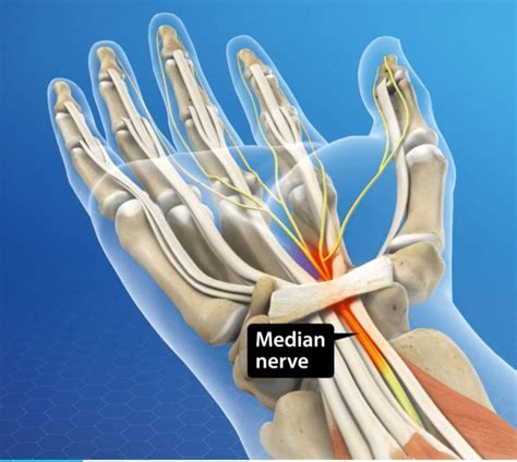 Median Nerve Florida Surgery Consultants