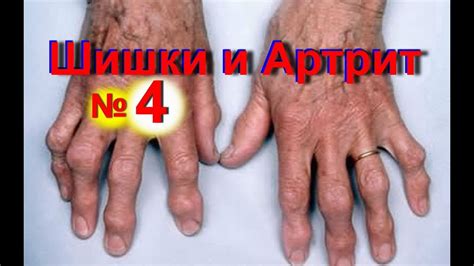 Шишки на пальцах рук как избавиться от шишек на пальце № 4 Артрит