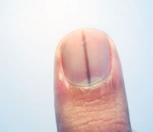 These are not merely a normal effect of passing years. Normal Black Line Under Fingernail vs. Melanoma Streak ...