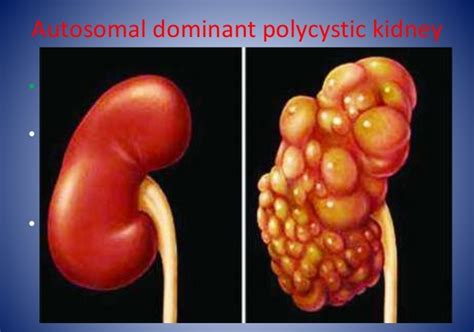 Prepare For Medical Exams Screening For Autosomal Dominant Polycystic