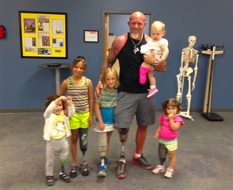 Steve Chamberland Helps Amputee Children Prosthetic