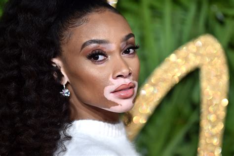 Why Model Winnie Harlow Is Calling Out The Tabloids For