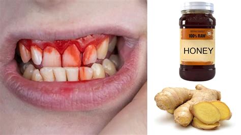 Home Remedies For Swollen And Bleeding Gums Natural Ways To Keep Your